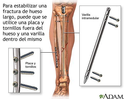 Dispositivos de fijación interna