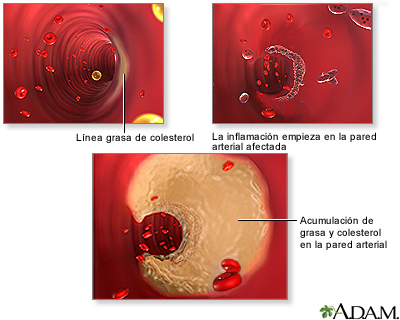 Acumulación de placa arterial