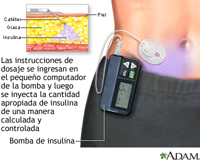 Bomba de insulina