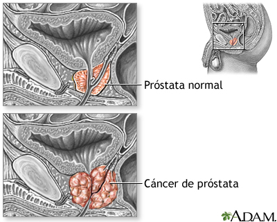 Cáncer de próstata