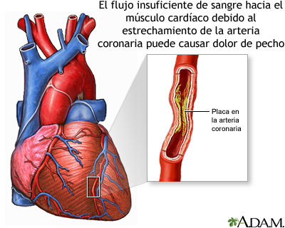 Angina