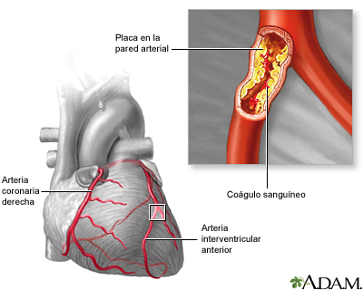 Aterosclerosis