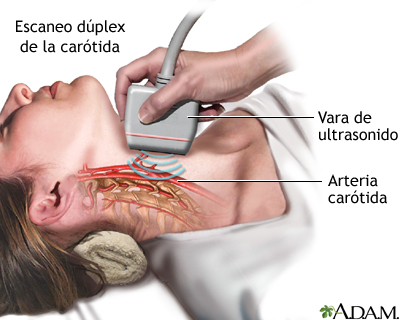 Dúplex de carótida