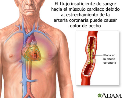 Angina estable