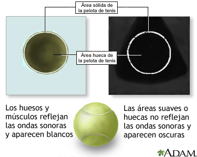 Comparación sobre el ultrasonido