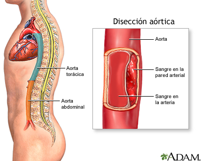 Disección aórtica