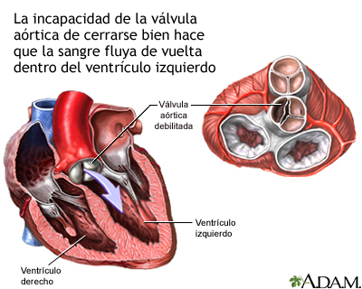 Insuficiencia aórtica