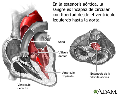 Estenosis aórtica