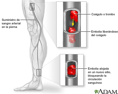 Embolia arterial