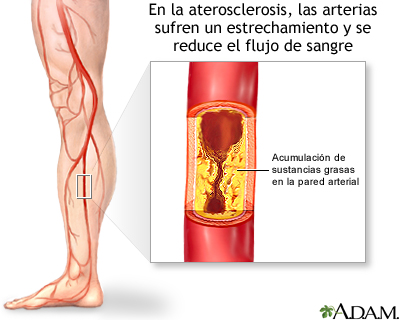 Arteriosclerosis de las extremidades