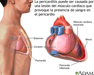 Pericarditis post-IM