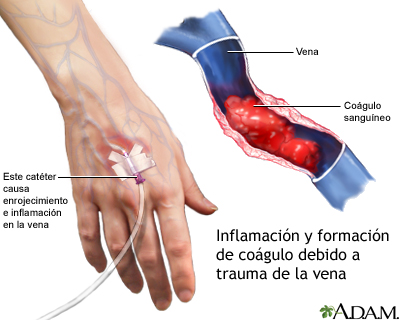 Tromboflebitis superficial