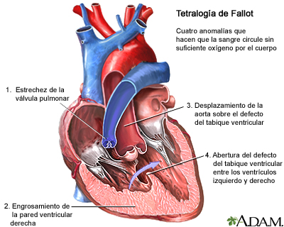 Tetralogía de Fallot