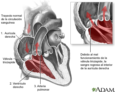 Regurgitación tricuspídea