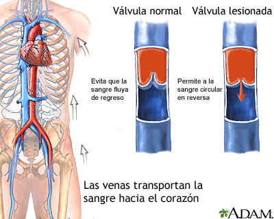 Insuficiencia venosa