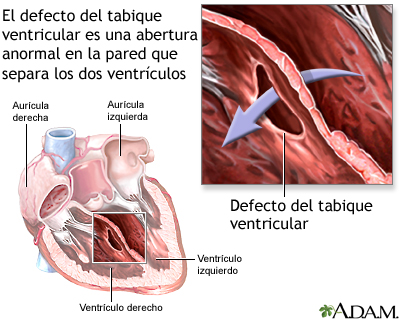 Defecto del tabique ventricular