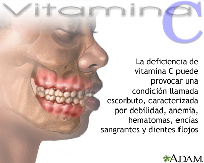 Déficit de vitamina C