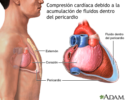 Taponamiento cardíaco