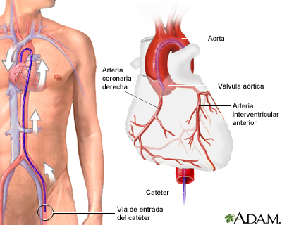 Angiografía coronaria