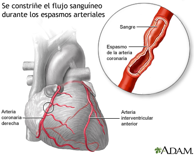 Espasmo de la arteria coronaria