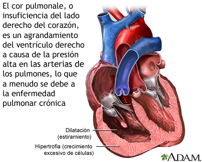 Cor pulmonale