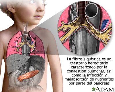 Fibrosis quística