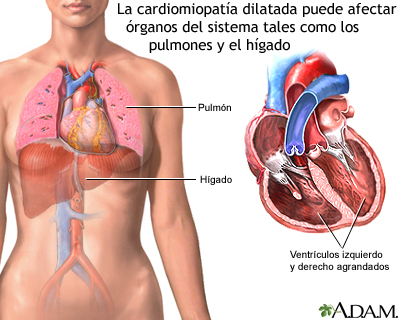 Cardiomiopatía dilatada