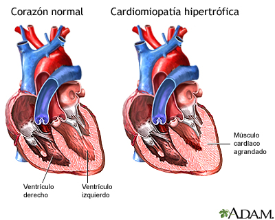 Cardiomiopatía hipertrófica