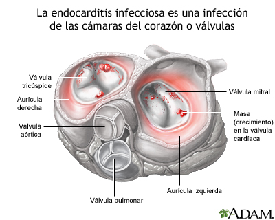 Endocarditis infecciosa