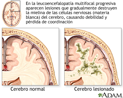 Leucoencefalopatía