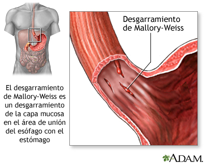 Desgarro de Mallory-Weiss