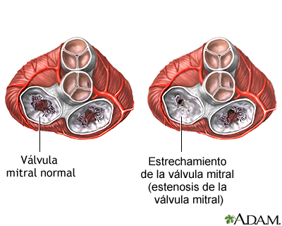 Estenosis mitral