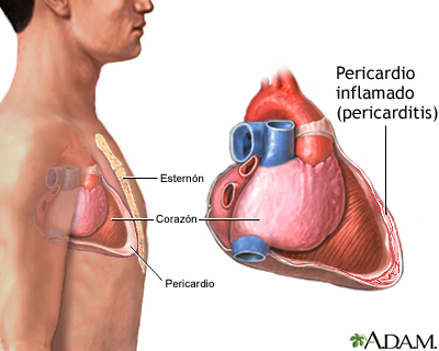 Pericarditis