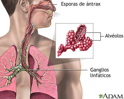 Inhalación de ántrax