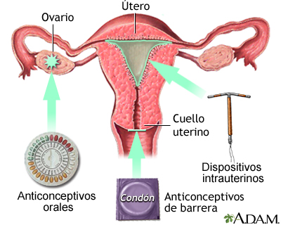 Métodos de control de natalidad