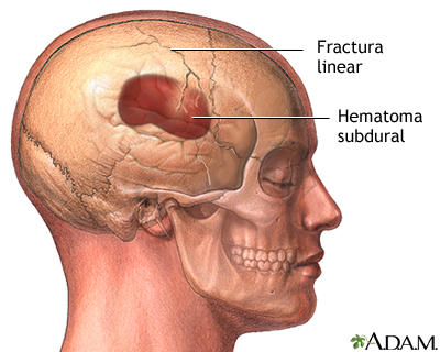 Fractura de cráneo