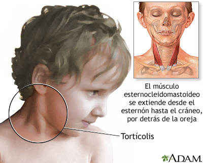 Tortícolis