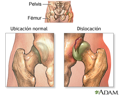 Dislocación de la cadera