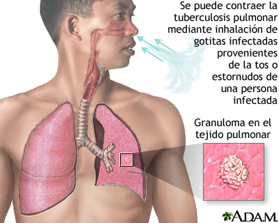 Tuberculosis pulmonar