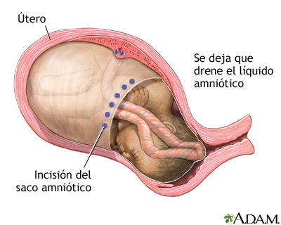 Procedimiento (cuarta parte)