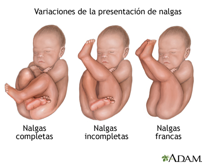 Tipos de presentación de nalgas