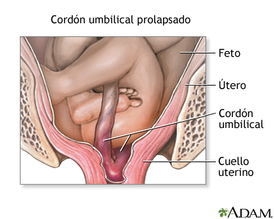 Complicaciones de la presentación de nalgas