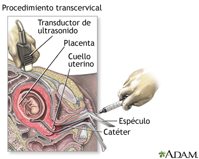 Procedimiento (segunda parte, transcervical)