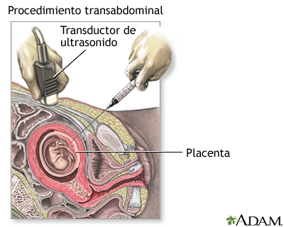 Procedimiento (segunda parte, transabdominal)