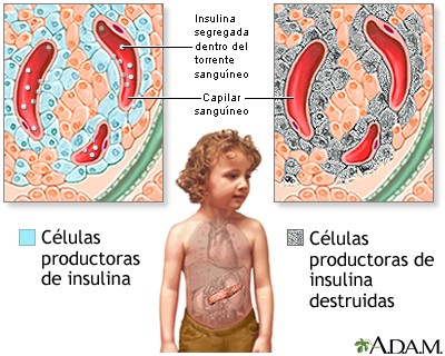 Diabetes tipo I