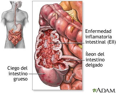 Enfermedad inflamatoria del intestino