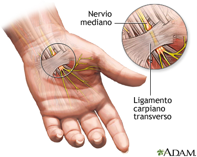 Compresión del nervio mediano