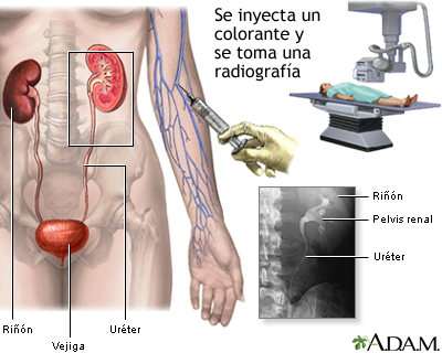 Pielograma intravenoso (PIV)