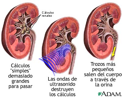 Litotripsia