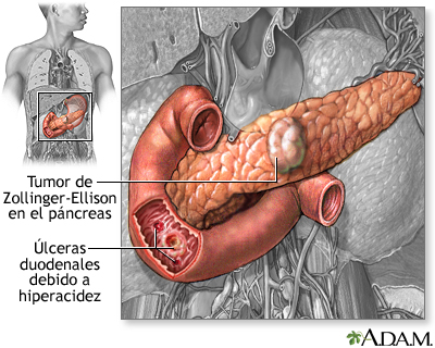 Causas de las úlceras pépticas